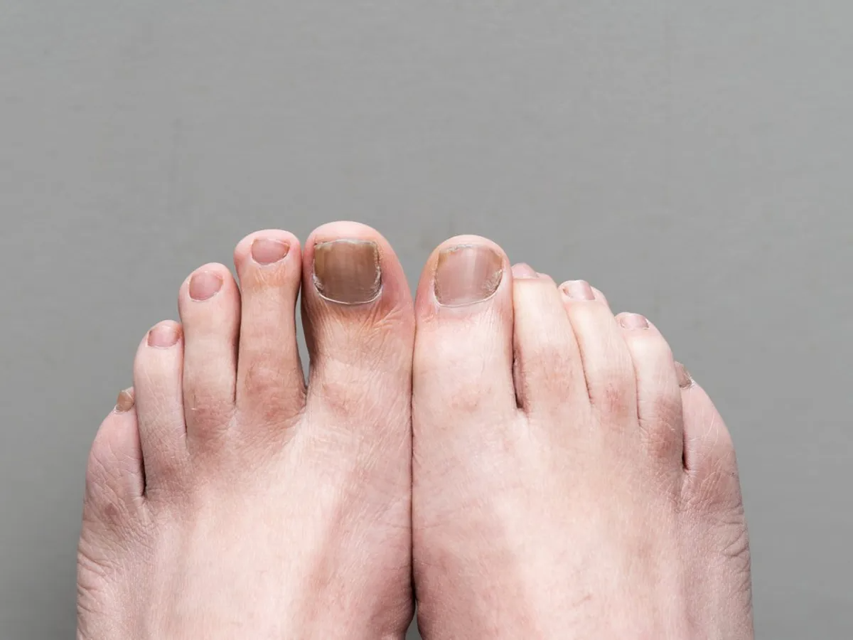 White Subtle Onychomycosis Treatment- Here Is A Guide For You